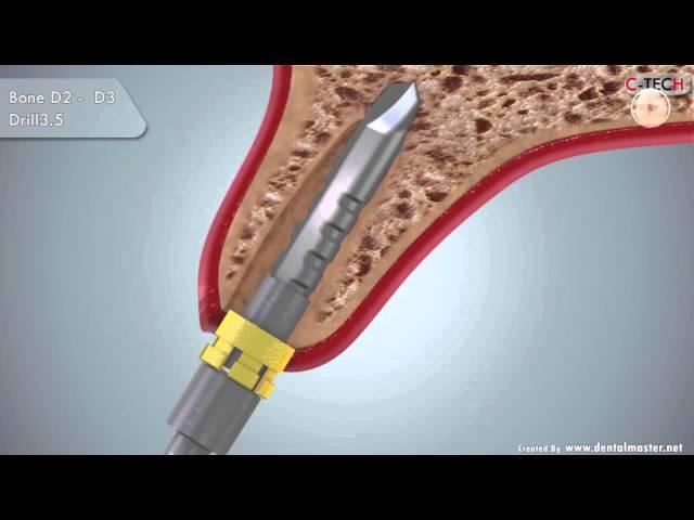 C-TECH EL Immediate Implant placement and loading protocol