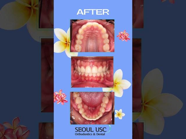 치간사이삭제를 통한 치아교정 #비발치치아교정 #치간삭제를통한공간확보 #치아교정 #orthodontics #단기치아교정