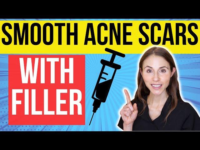 Filler For Acne Scars | Dermatologist Explains
