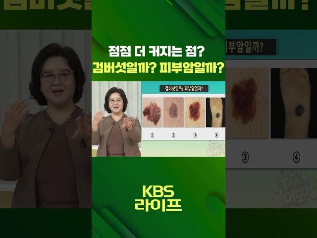 점점 더 커지는 점?  검버섯일까? 피부암일까? [무엇이든 물어보세요] | KBS 방송