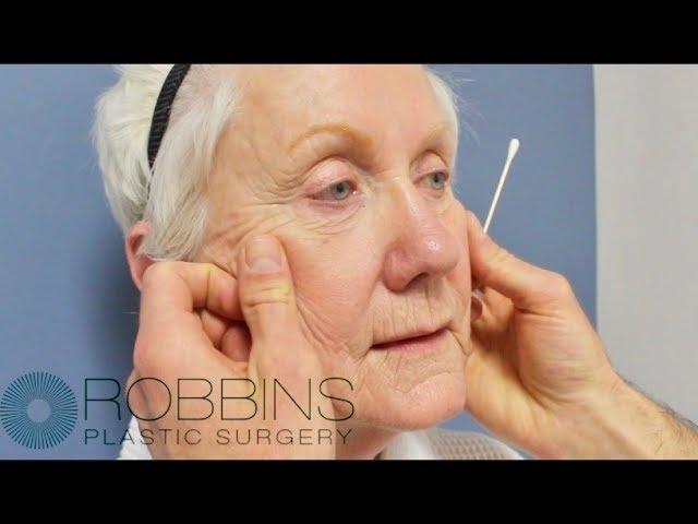 FACELIFT SURGERY- Award Winning " Best of Nashville" Plastic Surgeon Dr. Chad Robbins