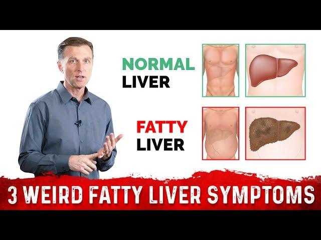 3 Weird Signs & Symptoms Of Fatty Liver – Dr.Berg