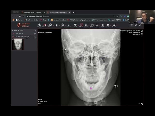 Skull X-Ray Diagnosis by Dr. Imran Lasker  Case 3/10  #ctimaging #xray #radiologyedu