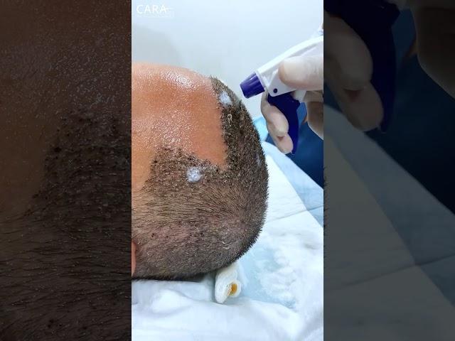 Headwash After Hair Transplant at Cara Clinic