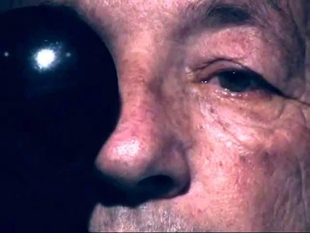 Fourth (4th) Cranial Nerve Palsy