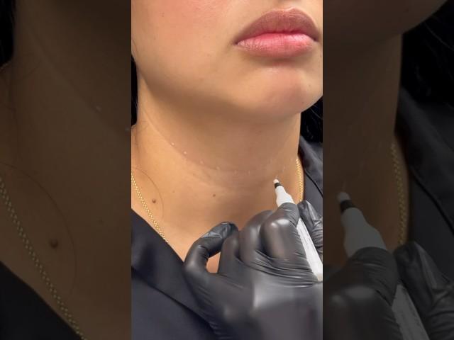 Mesotox - small, diluted doses of botulinum toxin administered into the dermal layer of the skin