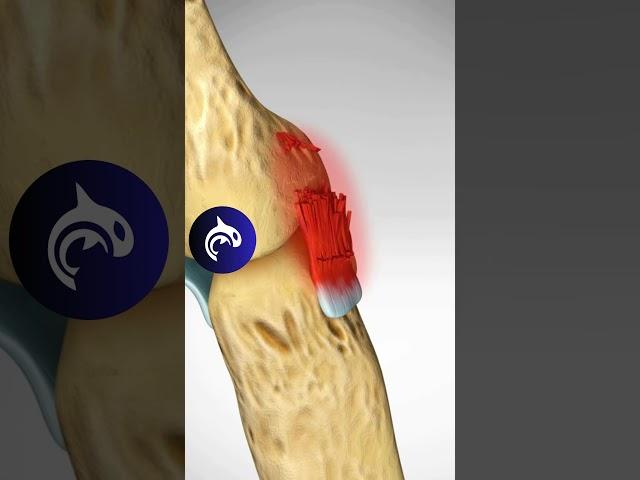 See what Skier's Thumb looks like in #3d #4k #hand