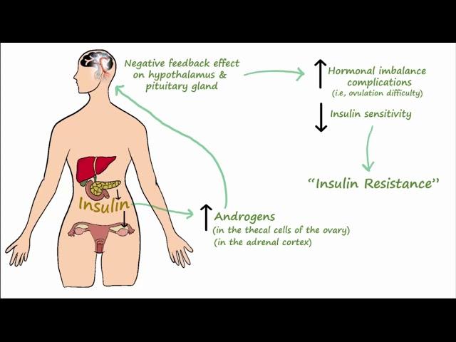 Polycystic Ovarian Syndrome (PCOS) - Pathophysiology, Symptoms, Treatment