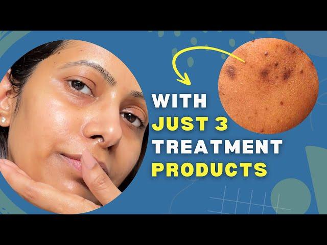 Only Skincare Products You Need to FADE stubborn BLACK brown acne marks spots on Face