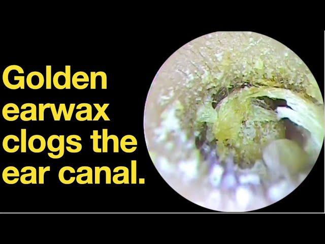 Golden earwax clogs the ear canal. |ear wax removal | ear cleaning | ASMR | relaxation | relax