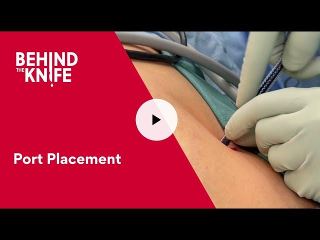 Behind the Knife - Port Placement