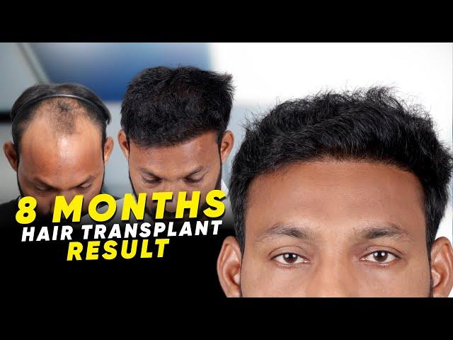 Hair Transplant in Chitradurga | Best Results & Cost of Hair Transplant in Chitradurga