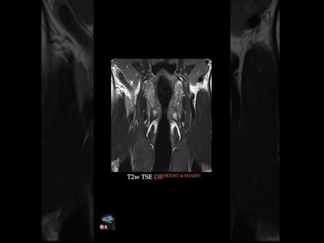 MRI – LARYNX @3T