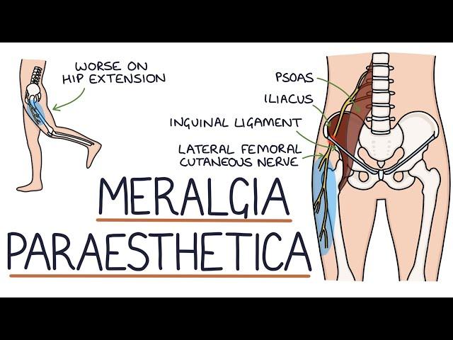 Understanding Meralgia Paraesthetica