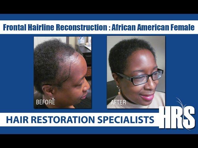 African American Hair Transplant at Hair Restoration Specialists of Atlanta