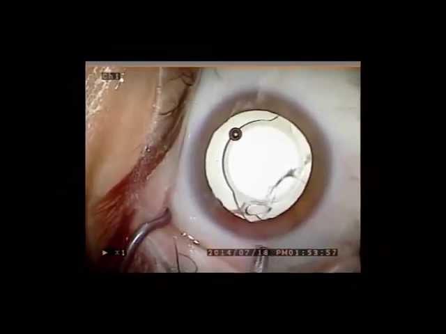 Dropless Cataract Surgery series