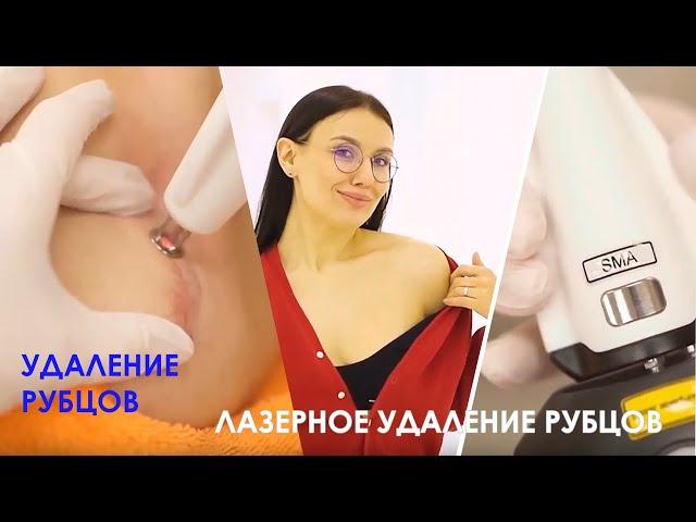Как ПОЛНОСТЬЮ УДАЛИТЬ РУБЕЦ / Лазерное удаление рубца на ключице [Линлайн Сеть клиник]
