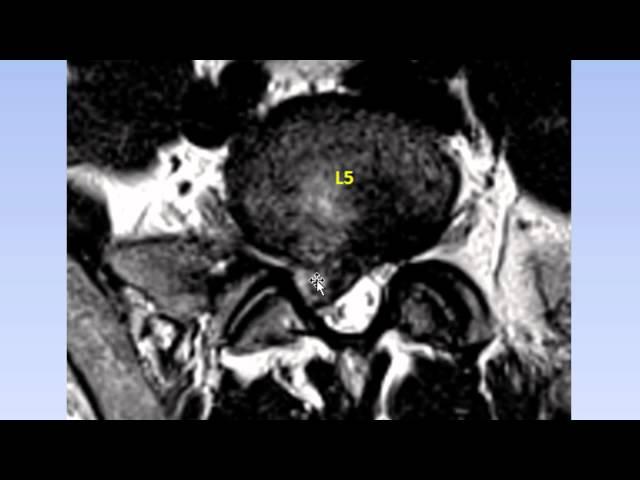 Dr. Gillard Lectures on Lumbar Disc Herniation / Protrusion. Part II of II.