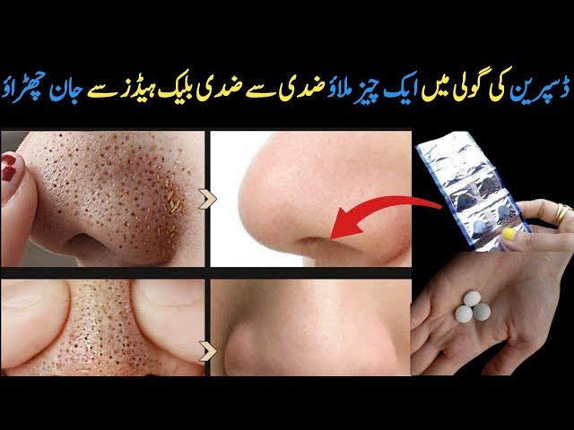 How to Remove Blackheads Permanently From Your Nose & Face Instantly |Naturaly at Home|No Whitehead