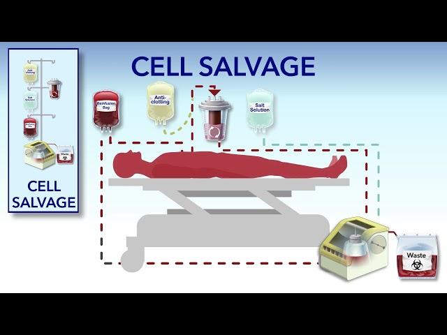 Cell Salvage and Hemodilution