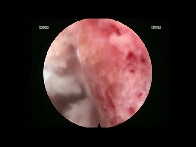 Endoscopic Disc Space Preparation for Fusion