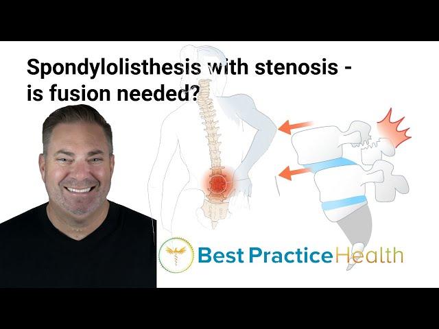 Is fusion necessary for the treatment of spondylolisthesis with stenosis? | Best Practice LIVE