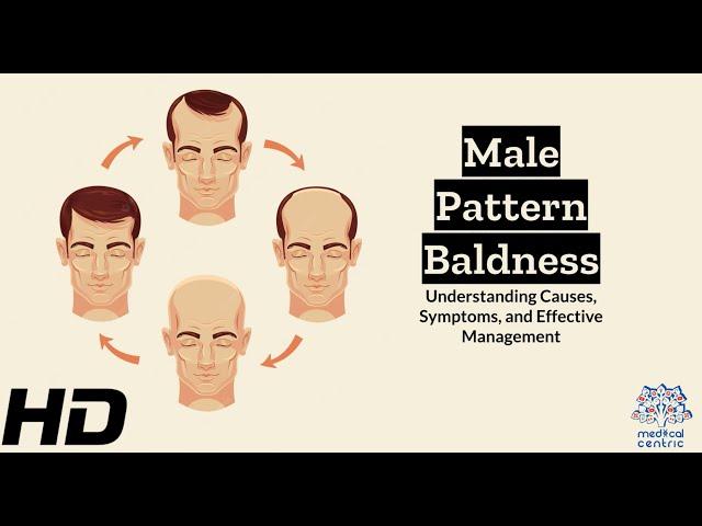 Male Pattern Baldness Explained: Everything You Need to Know