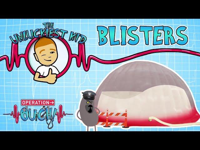 Science for kids | BLISTERS | Experiments for kids | Operation Ouch