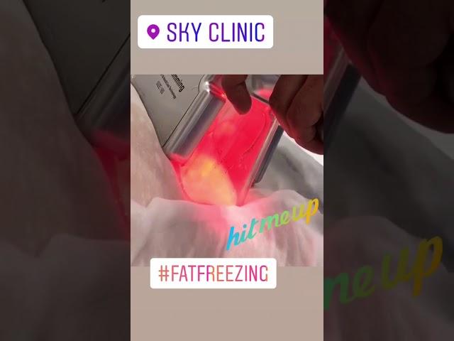 Fat Freezing Cryolypolisis at Sky Clinic Birmingham uk