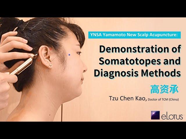 YNSA Yamamoto New Scalp Acupuncture: Demonstration of Somatotopes and Diagnosis Methods