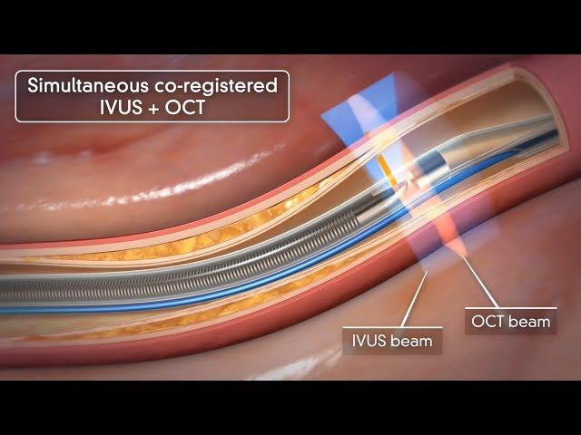 Novasight Hybrid System | Conavi Medical