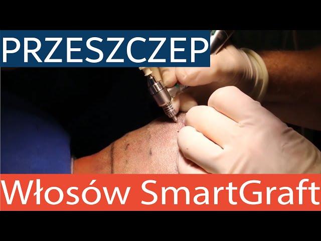 Przeszczep włosów Smart Graft - rewolucyjne i trwałe efekty, już w Polsce!