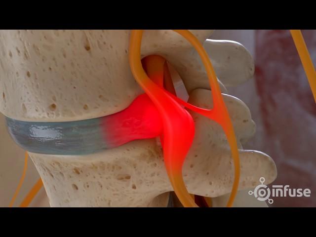 Discectomy Medical Animation - Infuse Medical