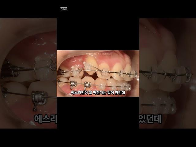 인터넷에서 봤는데, 에스라인 장치가 잘 깨지나요?  #교정중생기는 #프라임S치과