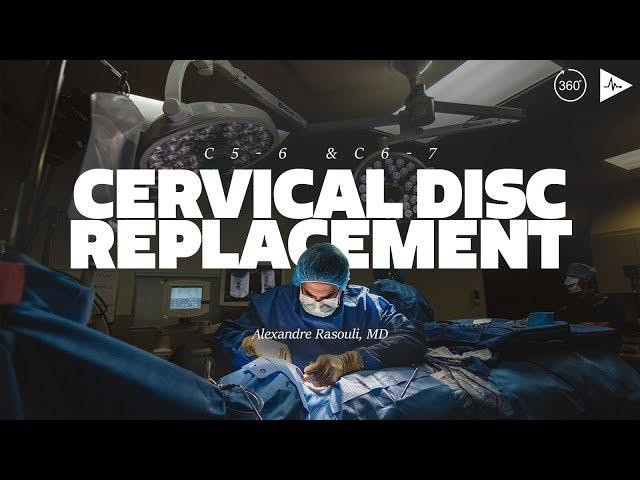 C 5-6 & C 6-7 Artificial Cervical Disc Replacement by Dr. Alexandre Rasouli | Case Trailer