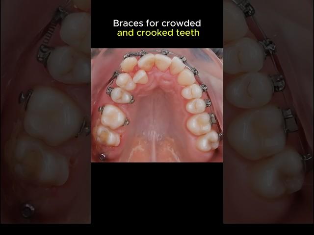 Braces for crowded and crooked teeth #orthodontist #braces #dentist