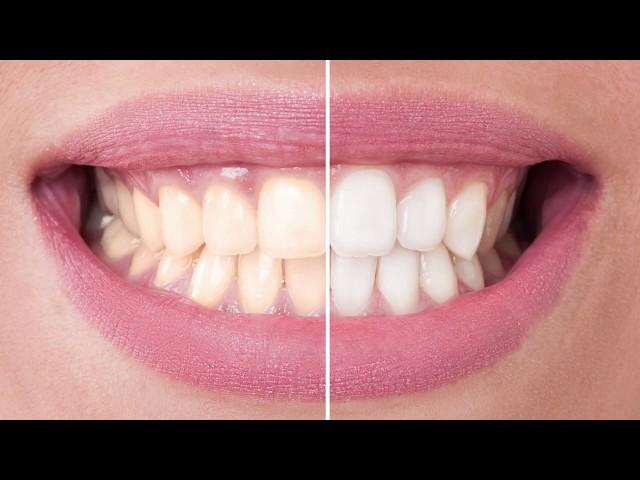 FAQ How can I whiten my teeth | Lakeshore Dental | Amrish Patel, DMD