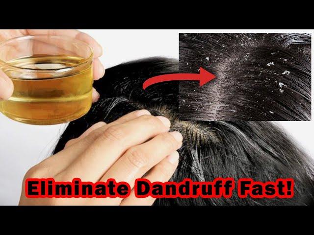 HOW TO GET RID OF DANDRUFF FAST | Home Remedies For Dandruff Removal