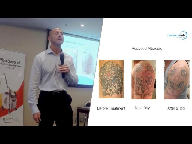 Advanced laser tattoo removal - Mixed Technology