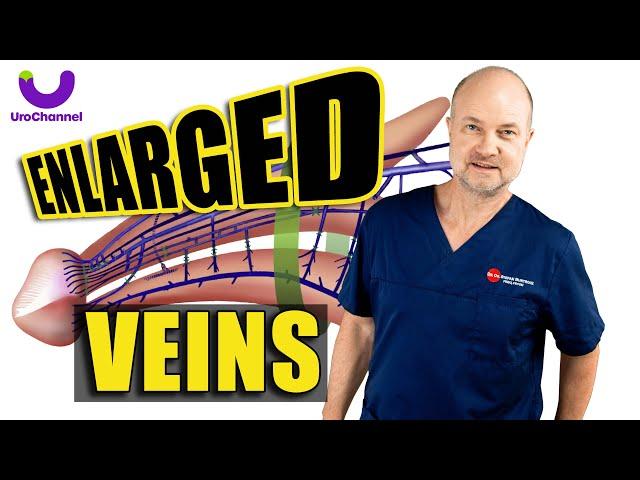 The Truth about Enlarged Penile Veins | UroChannel