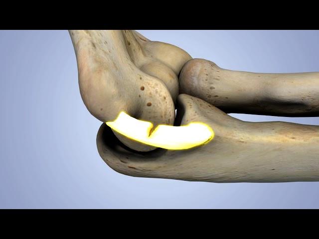 Kinduct - UCL "tommy john" 3D Animation