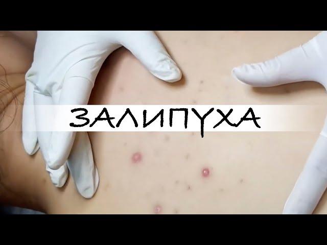 ПРЫЩИ. ДАВИМ ПРЫЩИ НА СПИНЕ. ВЫДАВЛИВАНИЕ ПРЫЩЕЙ НА СПИНЕ #прыщи #acne #asmr #прыщинаспине