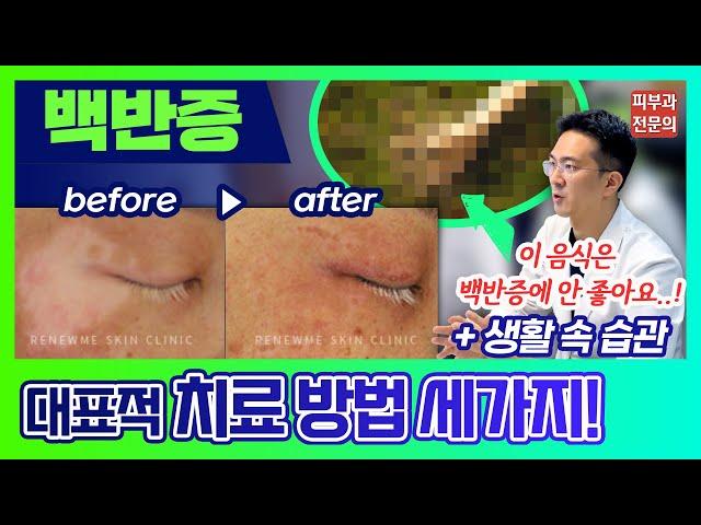 '백반증' 팩트 체크! [치료방법∙헷갈리는 질환∙생활습관∙나쁜 음식∙보험 등]