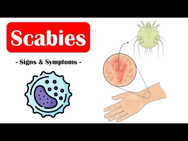 Scabies - Signs & Symptoms |What Are The Commonest Signs & Symptoms Of Scabies?