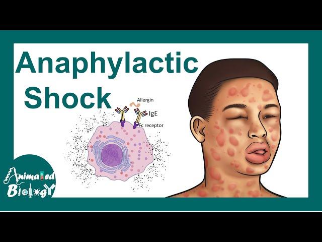 Anaphylactic shock | Anaphylactic Reaction: Symptoms and Treatment