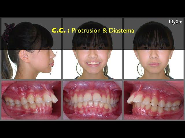 Solving Full cusp Class II with 12mm OJ｜【Chris Chang Ortho】CC742