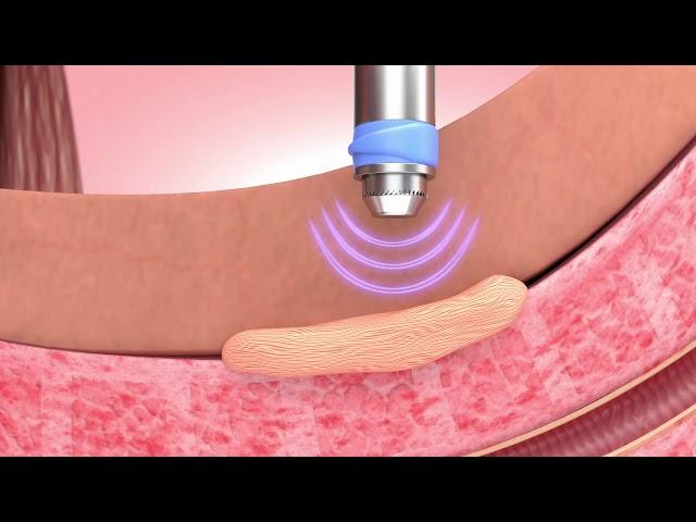 Peyronie's Disease treatment Animation