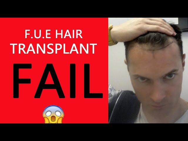 My Disaster FUE  Hair Transplant Failed! FARJO HAIR INSTITUTE.