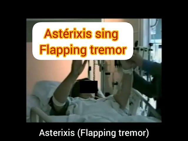 Astérixis sign (flapping tremor)