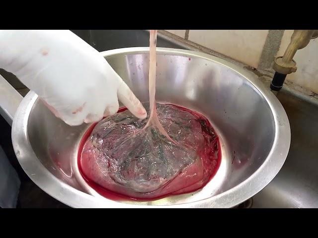 Placenta examination